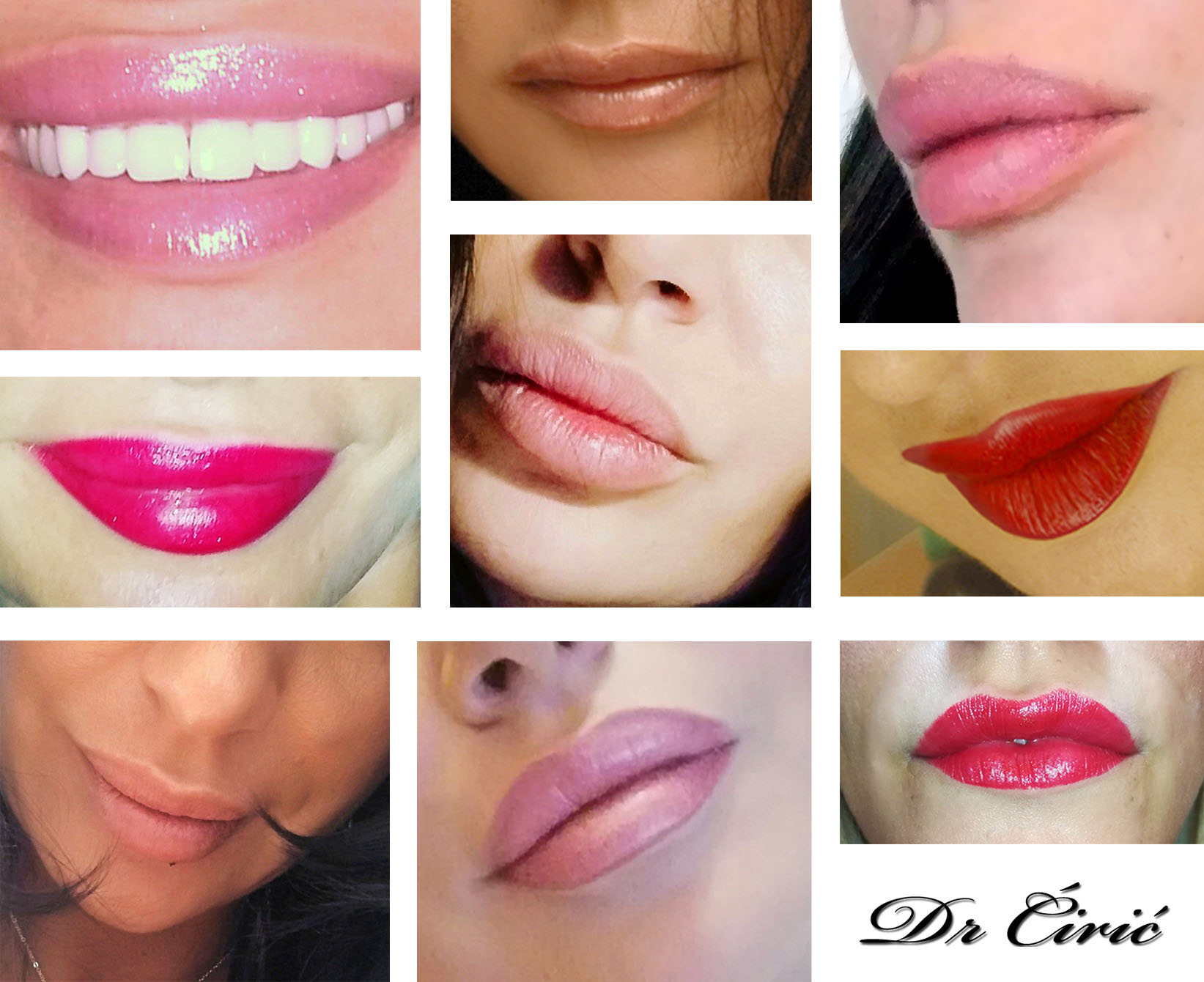 Povecanje usana Pre / Posle intervencije