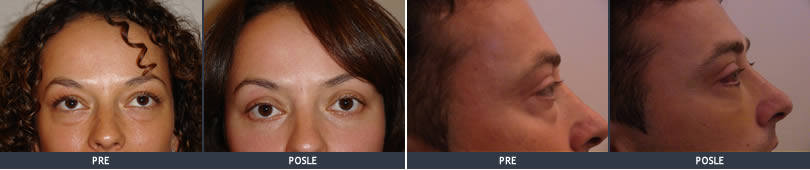 operacija kapaka slike