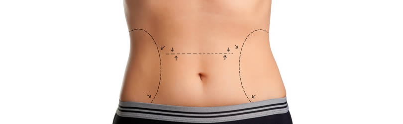 Abdominoplasty