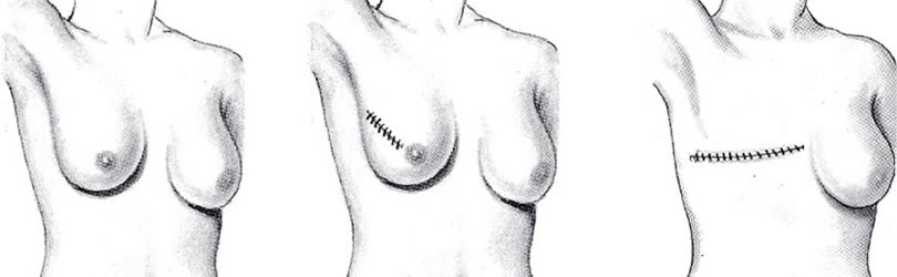 Breast reconstruction