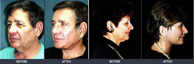 Face eyelids forehead and neck lifting