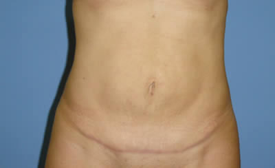 abdomenoplastika-2-posle