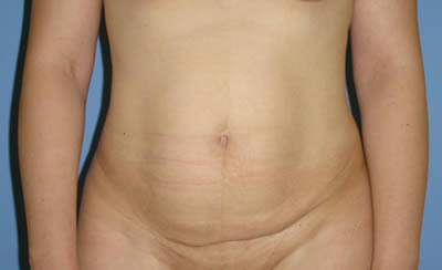 abdomenoplastika-2-pre
