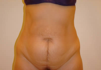 abdominoplastika slike 7 pre