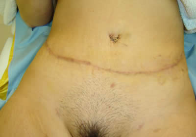 abdominoplasty picture 7 after