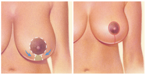 breast-reduction-incisions-1
