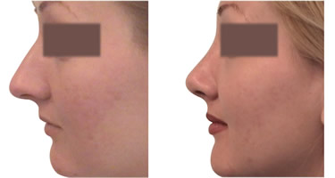 dr-ciric-rinoplastika-pre-posle-intervencije