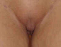 genitoplastika 1 posle