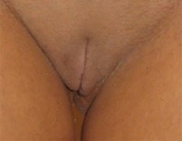 genitoplastika 1 pre