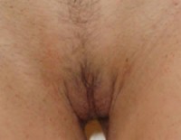 genitoplastika 2 posle