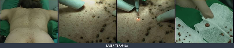 laser terapija slike