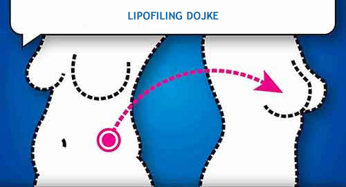 lipofiling dojke