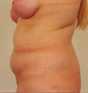 liposukcija 4 before