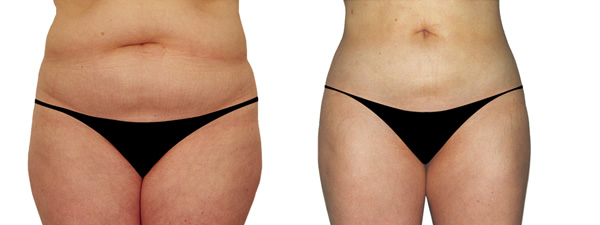 liposukcija pacijent pre i posle intervencije dr ciric