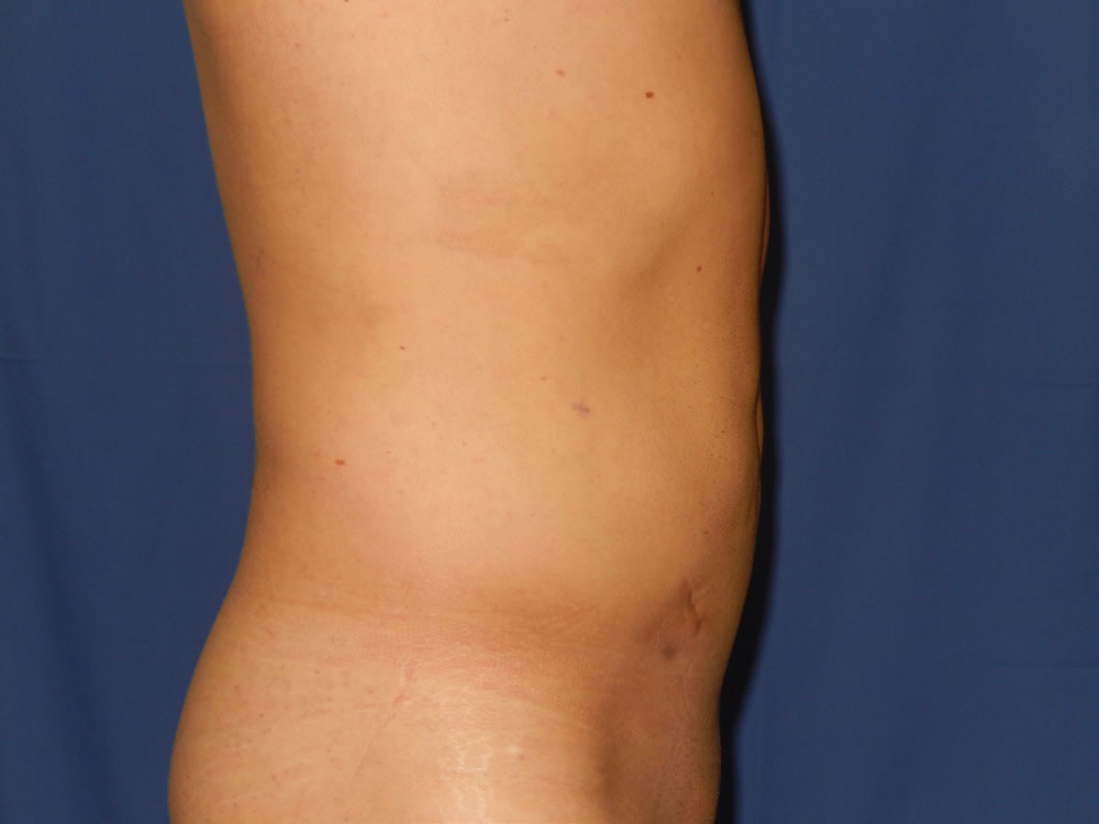 liposukcija2-posle