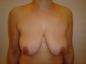 podizanje grudi 1 - pre