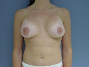 povecanje grudi 5 - posle