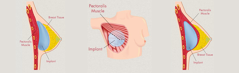 pozicija implantata slika