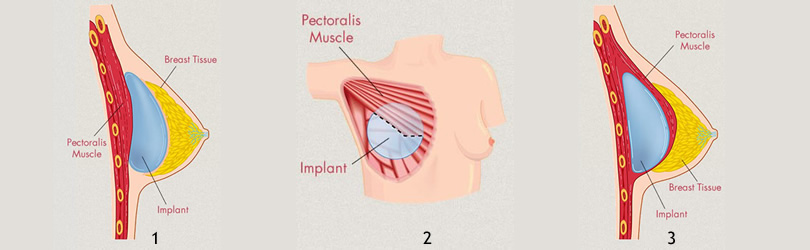 pozicija-implantata-za-grudi-slika