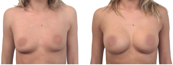 uvecanje grudi silikonima pre posle 2018