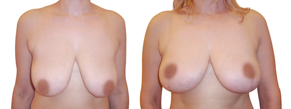 zatetanje i podizanje grudi 2018