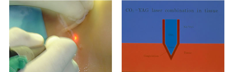 laser povecanje grudi slika 1