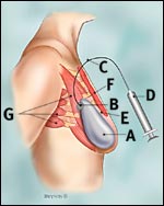 brustrekonstruktion-1