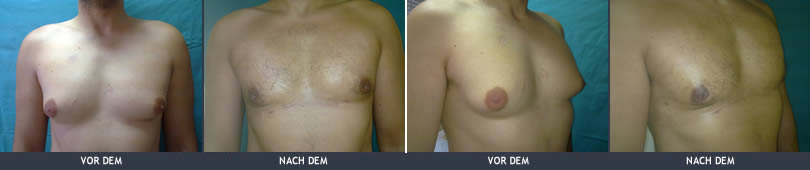 brustverkleinerung-bei-mannern-gynakomastie