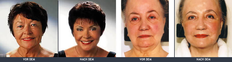 lipofullung-des-gesichts