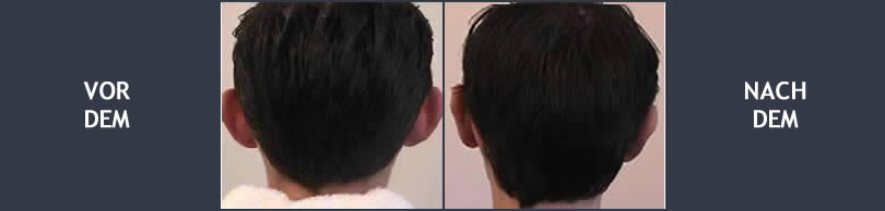 ohranlegeplastik-ohrenkorrektur