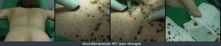 nf1-laser-therapie