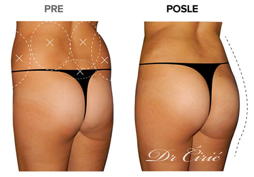 Zatezanje zadnjice pre posle