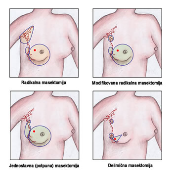 vrste mastektomije sl 3