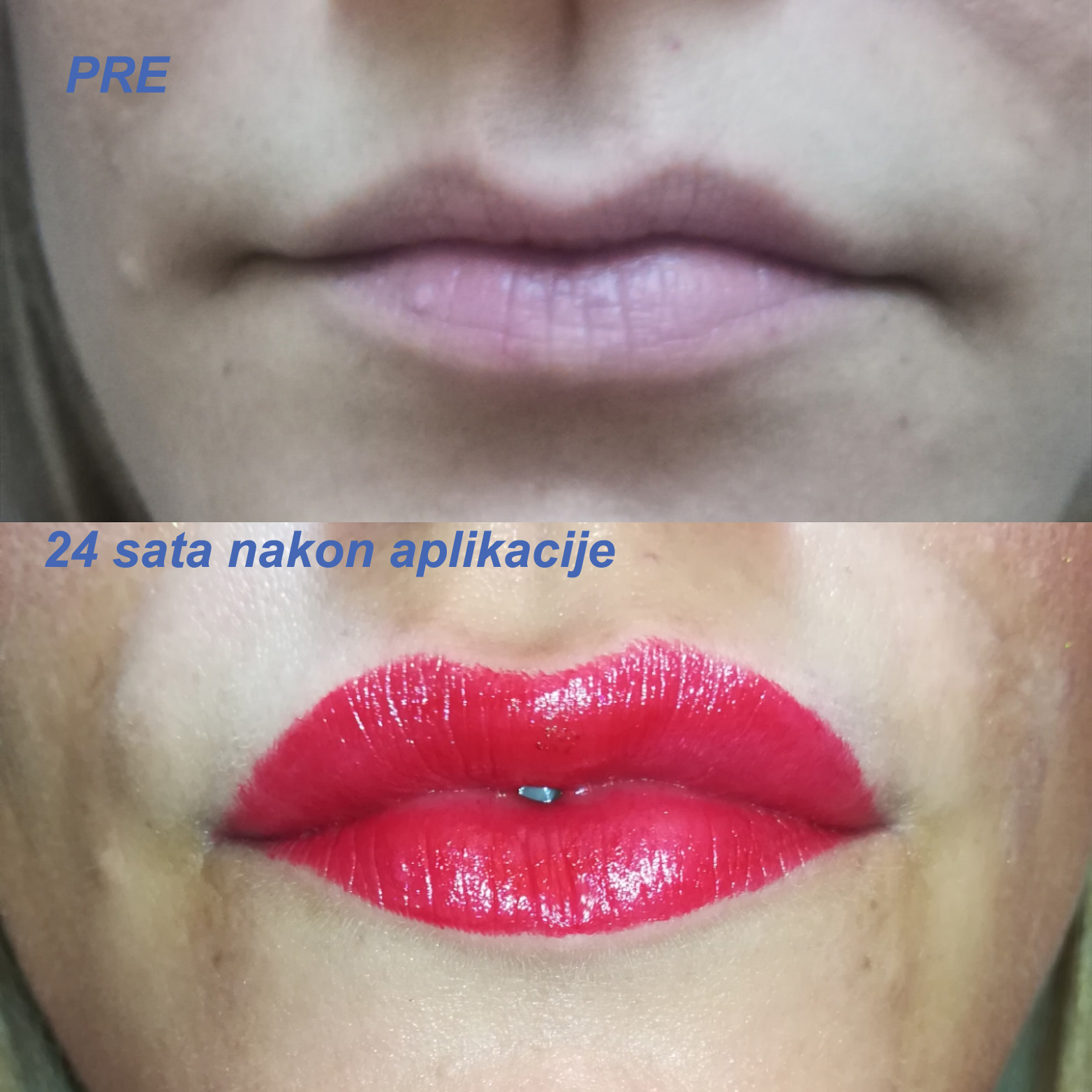 Povećanje usana PRE POSLE