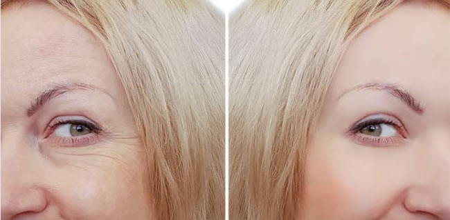 botulin toksin blog pre posle