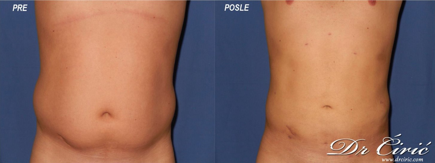 primer abdominoplastika