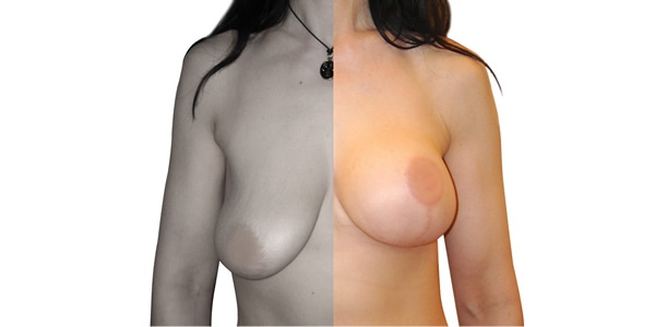 podizanje i zatezanje grudi dr ciric