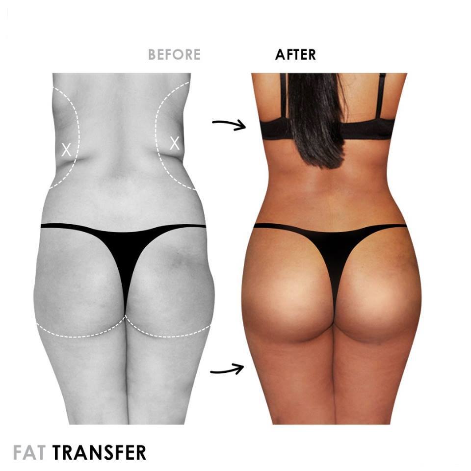 Buttock augmentation and reshaping with own fat tissue - Aesthetic