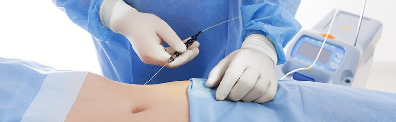 Laser Assisted Liposuction-Laser Lipo - Aesthetic plastic surgery
