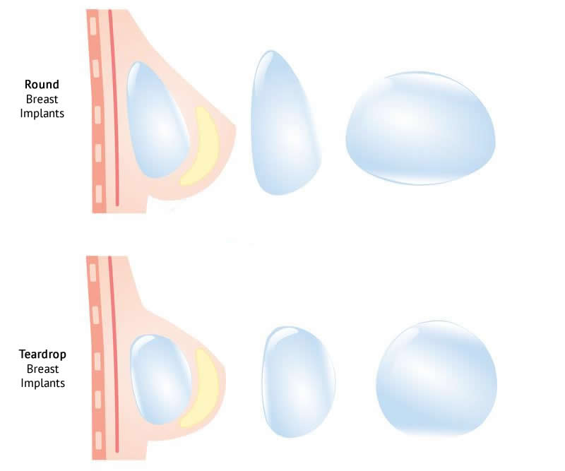 Round vs. Teardrop Breast Implants - Aesthetic plastic surgery DR ĆIRIĆ