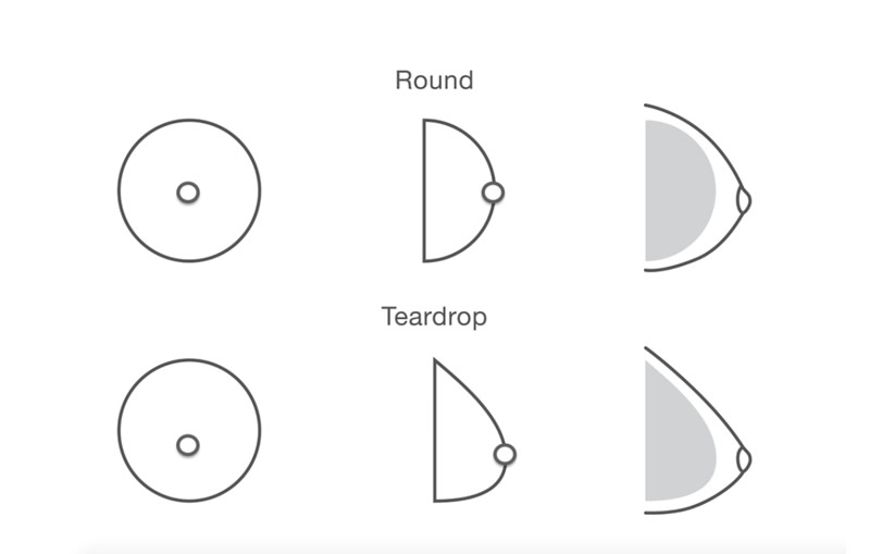 Round vs. Teardrop Breast Implants - Aesthetic plastic surgery DR