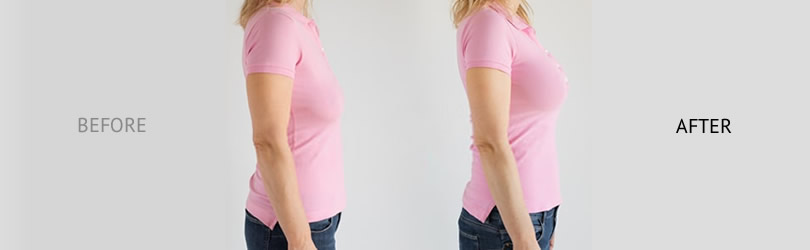 Fat Transfer Breast Augmentation - Breast Lipofilling - Dr Ciric