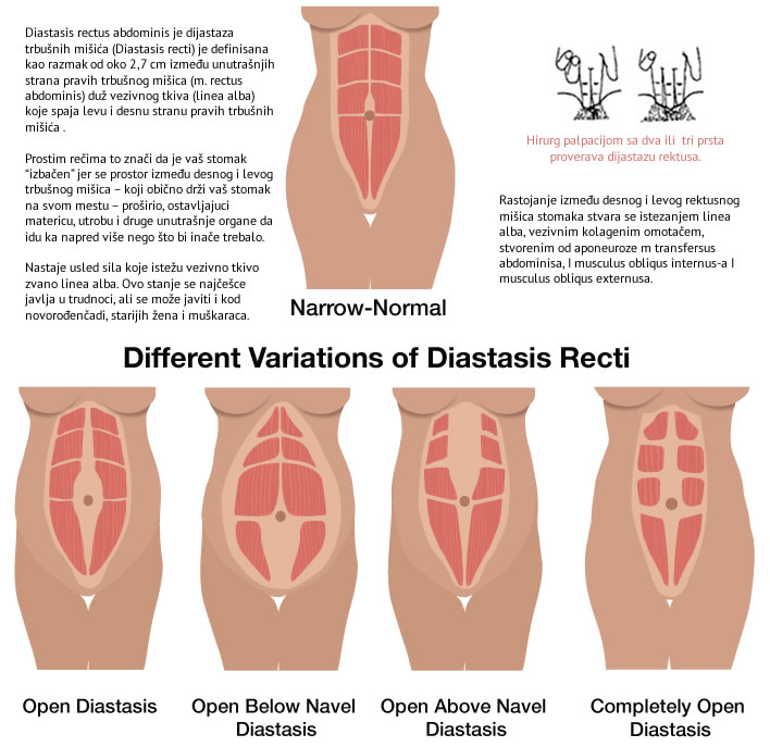 dijastaza rektusa lecenje