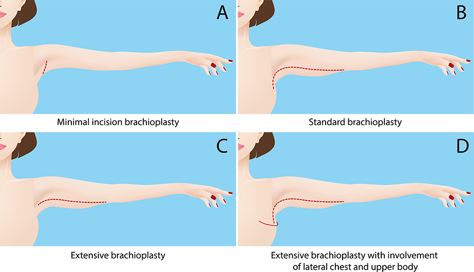 armliftdiagramdrciric Estetska plastična hirurgija DR ĆIRIĆ