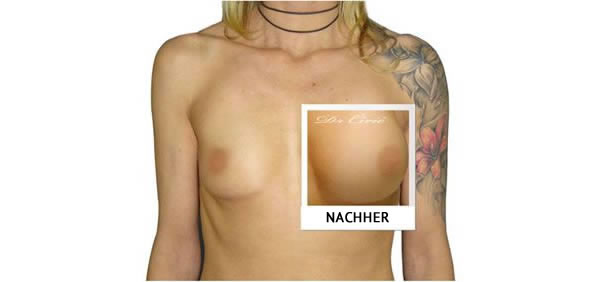 povecanje grudi galerija dr ciric