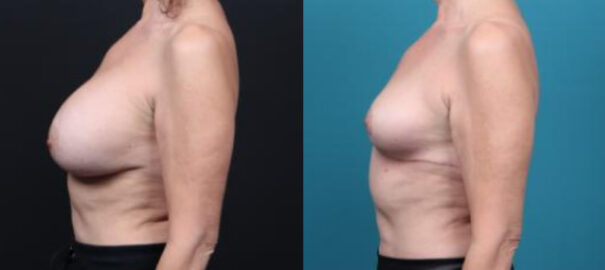 Vadjenje implantata iz grudi-eksplantacija