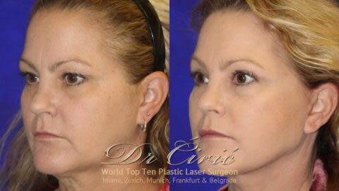 LASER-face-lifting-SRB-480x270 LASER-face-lifting-SRB-480x270