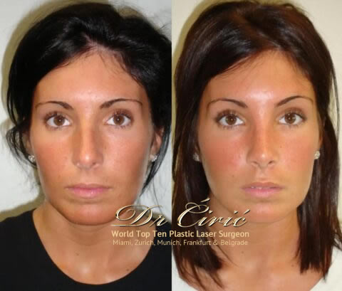 Laser-SMAS-Face-Neck-LIft-480x409 Laser-SMAS-Face-Neck-LIft-480x409