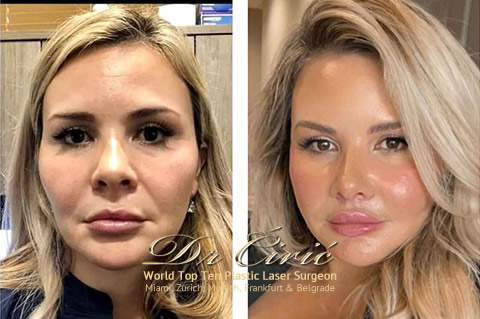 Najbolji-FACE-LIFT-Lifting-u-Srbiji